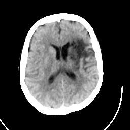 CT image of the brain